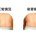 让孩子更“正直”！脊柱侧弯要早发现、早纠正_2