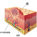 ԽԽ࣡ϳС񣬻HPVȾ_5