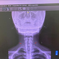 漂流甩头加养生馆按摩，让我发现自己脖子上多了2根肋骨_3