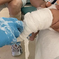 因为长了一只“马蹄”，娃刚满月就被打了石膏_5