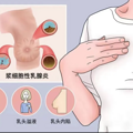 30岁女子胸部成“马蜂窝”！警惕这种“不死癌症”_2