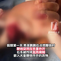 寒假第一天手就废了！8岁男孩手指皮肉被炸飞，只剩骨头！