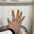 16岁男孩身高疯长到199cm！检查后发现体内长了个……_2