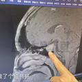 16岁男孩身高疯长到199cm！检查后发现体内长了个……_3
