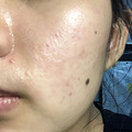 满脸的红斑和丘疹，让我成为诊室里穿着白大褂的病人_0