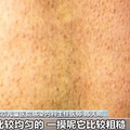 高热不退全身起疹“像鸡皮疙瘩一样”，甚至出现血尿！又到高发期_4