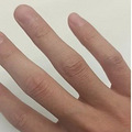 伸手阻挡老婆扔来的枕头，我手指成了“倒直角”形状