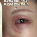 毒液堪比硫酸！一地确诊200多例，紧急提醒：不要拍_3