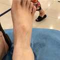 从楼梯滑飞后，我收获了一只骨头上有洞洞的脚踝_3