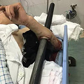 可怕！台州男子手臂被保温杯粗的钢棍击穿