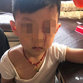 3岁男童电梯里被大型犬袭击，脸上抓出10厘米血印！妈妈一查监_1