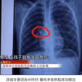 夏天孩子该不该戴银手镯？11个月宝宝手脱臼就因为它_5