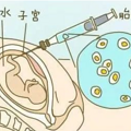 羊水穿刺不可怕，生育有问题孩子才可怕