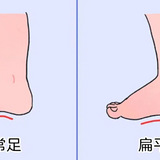宝宝有些足外翻，是扁平足吗？快来自测一下