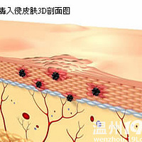 飞蛇病会传染吗?!为什么会得飞蛇病?!带状疱疹