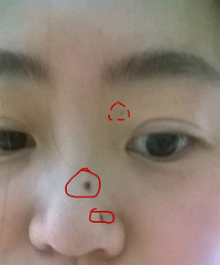 开帖记录--------我的“点痣”日记(重口慎入)