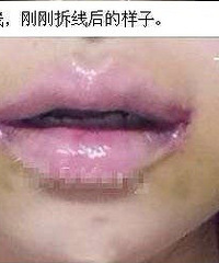 有没有想整容做嘴角的?一起来感受下嘴角上扬术的惊人效果吧