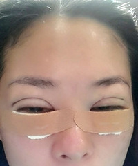 我是刘策励的小伙伴+无痕双眼皮/内切眼袋+美眼成形记