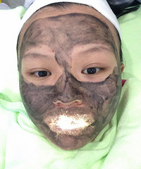 我来发一个迪邦的黑脸娃娃+祛痣的报告