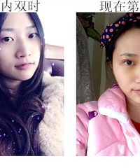 为了婚礼能美美的,我去做了双眼皮+开眼角手术