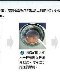 桃子带你去爱尔眼科近视交流大会,了解那些近视手术必知事