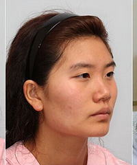 ������Ŀ��vline+�۾�+֬�����