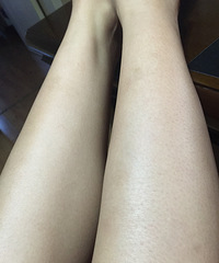 咪咪四肢脱毛体验··