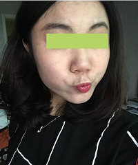 论坛红人推荐的祛痘痘店,我的第一个反馈贴