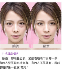 不要眼袋,不要黑眼圈,我只要卧蚕!5分钟卧蚕成型术