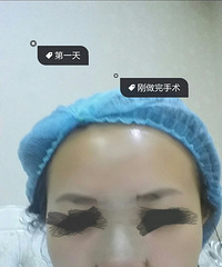 天妃做了假体隆鼻 每天自拍看自己的变化