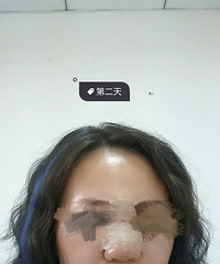 天妃做了假体隆鼻 每天自拍看自己的变化