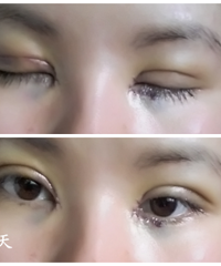 我的双眼皮和内眼角恢复+减肥 记录、留给自己的回忆!!
