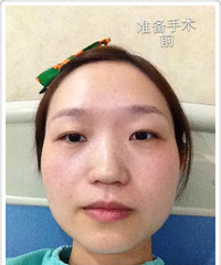 隆鼻+垫下巴+瘦脸针(双眼皮+怯眼袋+自体脂肪填充待做)