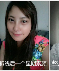 全切双眼皮+开内眼角+祛眼袋(刘策励的小伙伴免费造美归来)