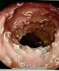 一位长期喜欢吃麻辣烫和米线的姑娘去做胃镜