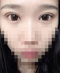 跟帖许了个愿,双眼皮直接少了300块