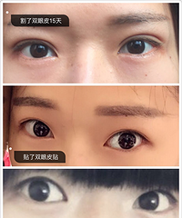 ~我和妹妹同一天去做了双眼皮~