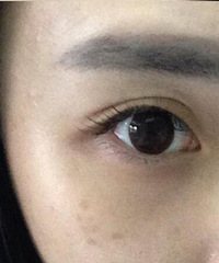 【真伊医疗美容医院】---我的祛斑初体验