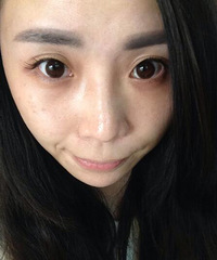 【真伊医疗美容医院】---我的祛斑初体验