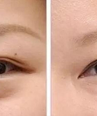 年龄不同,去眼袋的方法也不同