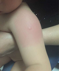 昨天打了育苗,今天又红又肿又硬…