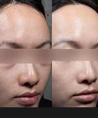 解决毛孔粗大、痘痘肌、暗黄的秘诀