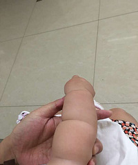 有没得人懂束带综合症的?