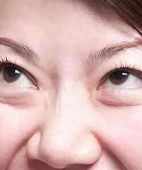 手术祛除眼袋那些事儿……