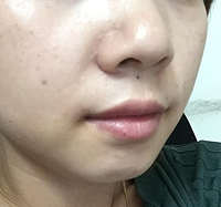 体验射频紧肤,20天后效果还不错