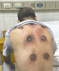 太吓人了!大爷拔一个月火罐 背上烧出7个"洞"