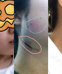 孕期遭遇牙痛,留下这么长的疤