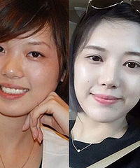 双眼皮+隆鼻+下巴 这效果看图吧