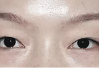 #美禅分享#这四种眼型,做了双眼皮颜值提升10000倍!