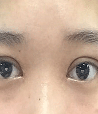 来聊聊我的双眼皮,全程最痛的居然是打麻药